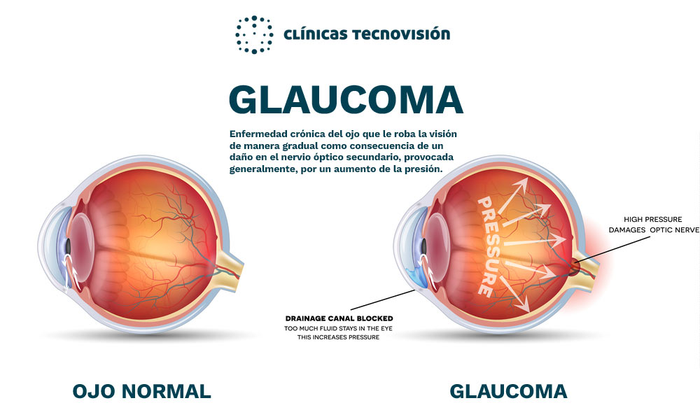 Sintomas de glaucoma