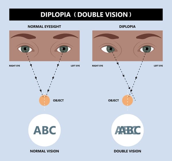 explicación gráfica de diplopia o vision doble